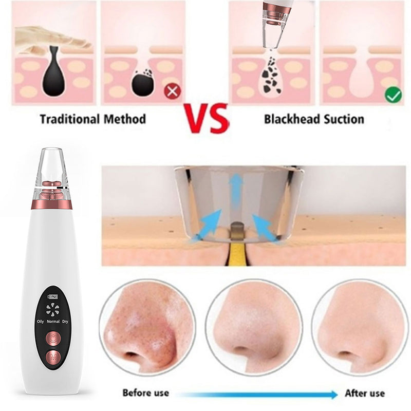 Blackhead Remover Vacuum | Pore Vacuum Cleaner | WhiteDiamonds